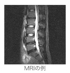 MRI例