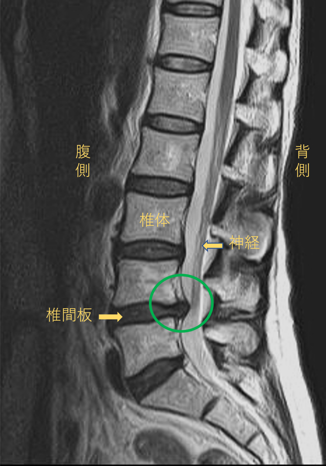 【PLDD法】2か月前から腰痛、左下肢の痛み、しびれがある50代女性【治療実績】 医療あれこれ日記 椎間板ヘルニアのレーザー治療